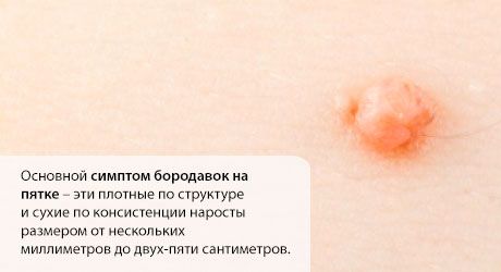 Бородавка на п'яті: що робити?