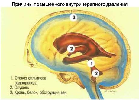 Підвищений внутрішньочерепний тиск 