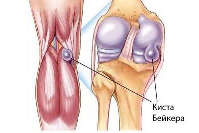Кіста Бейкера