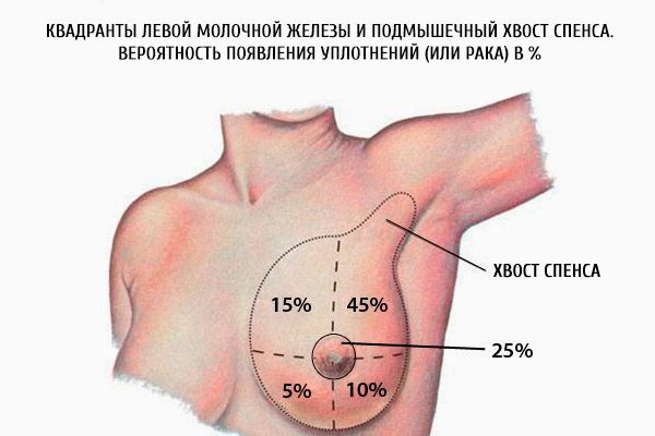 Квадранти лівої молочної залози і пахвових хвіст Спенс.  Імовірність появи ущільнень (або раку) в%