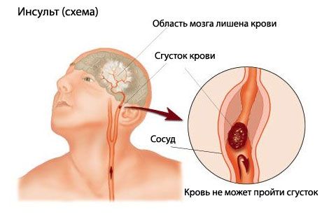 Простий тест передбачає смертельний інсульт